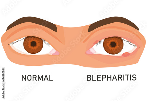 illustration of eyes with barley. eye diseases. eyelid inflammation. blepharitis. flat vector. isolated on white background. photo