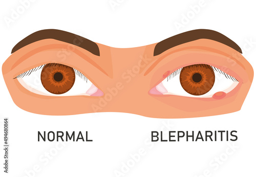 illustration of eyes with barley. eye diseases. eyelid inflammation. blepharitis. flat vector. isolated on white background.