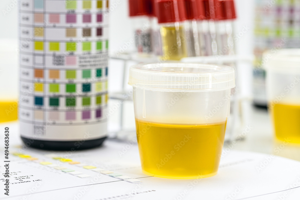 urine bottle, urinalysis to analyze Leukocytes, Urobilinogen, Bilirubin