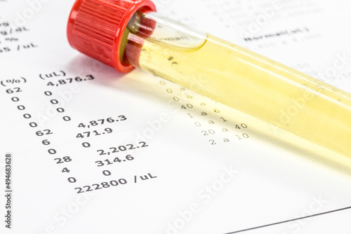 urine vial in laboratory, toxicology or routine examination photo