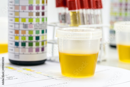 urine bottle, urinalysis to analyze Leukocytes, Urobilinogen, Bilirubin, Blood, Nitrite, pH, Density, Protein, Glucose and ketone bodies (ketosis) photo