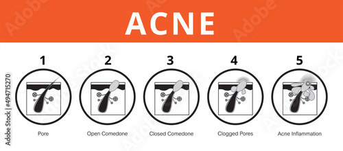 Acne, stages of development, healthy skin, vector design
