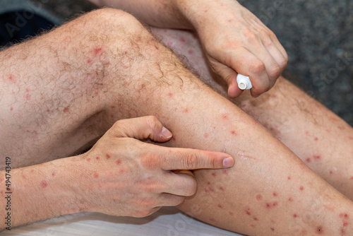 Bitten arms and legs by bloodthirsty insects in tropical countries, Lubricating itchy spots with ointment, Holiday health problems photo