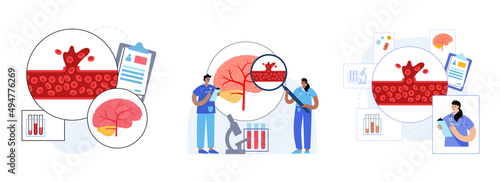 Brain stroke hemorrhagic