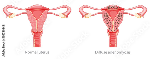 Diffuse Adenomyosis Human anatomy Female Sick and normal reproductive system organs. Location scheme Cross section uterus, cervix, ovary, fallopian tube icon. Vector illustration isolated on white