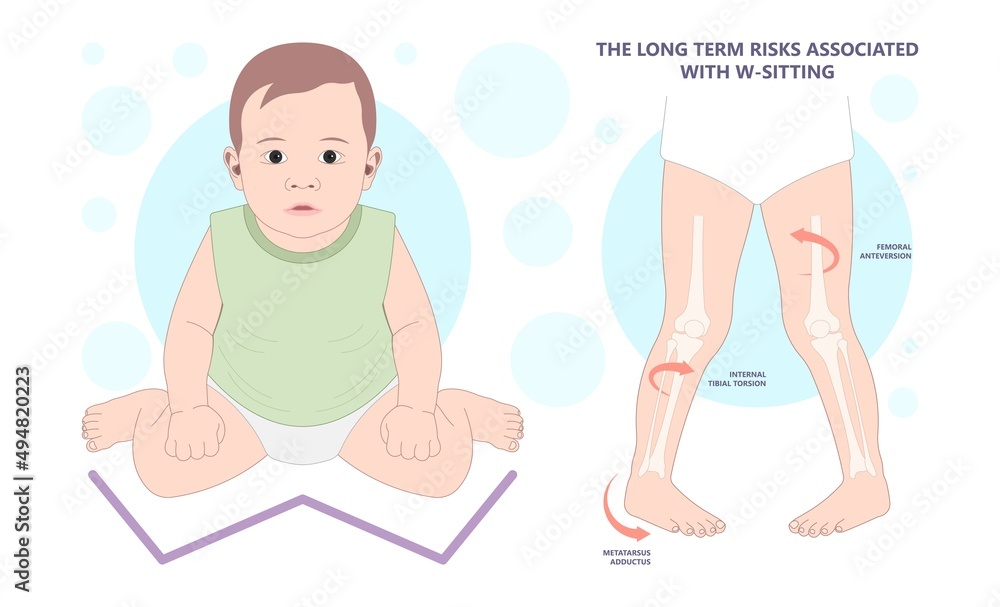 Obraz w ramie injury Birth infant genu valgum varum criss cross and