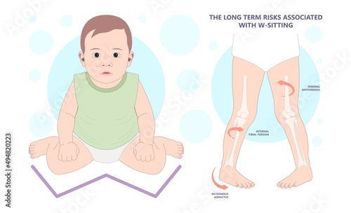 injury Birth infant genu valgum varum criss cross and club foot tailor body side W Sitting wrong bad position of bent hip Bow leg knock knees in core kids children baby back pain poor toed walking