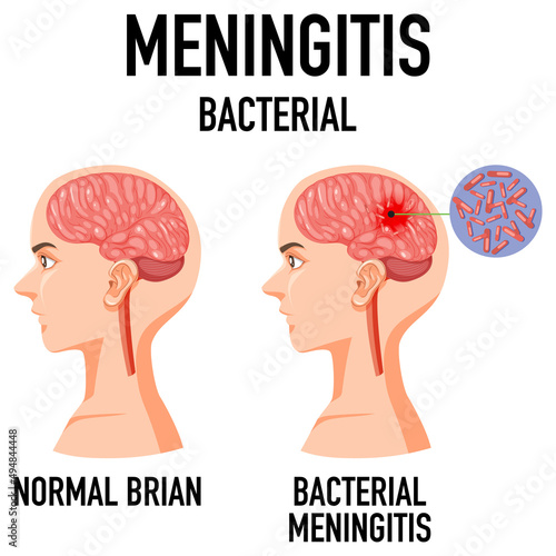 Diagram showing meningitis bacterial in brain