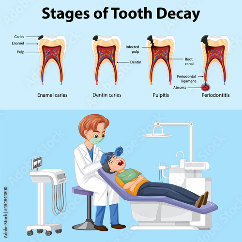 Poster stages of tooth decay with dentist man examining patient teeth