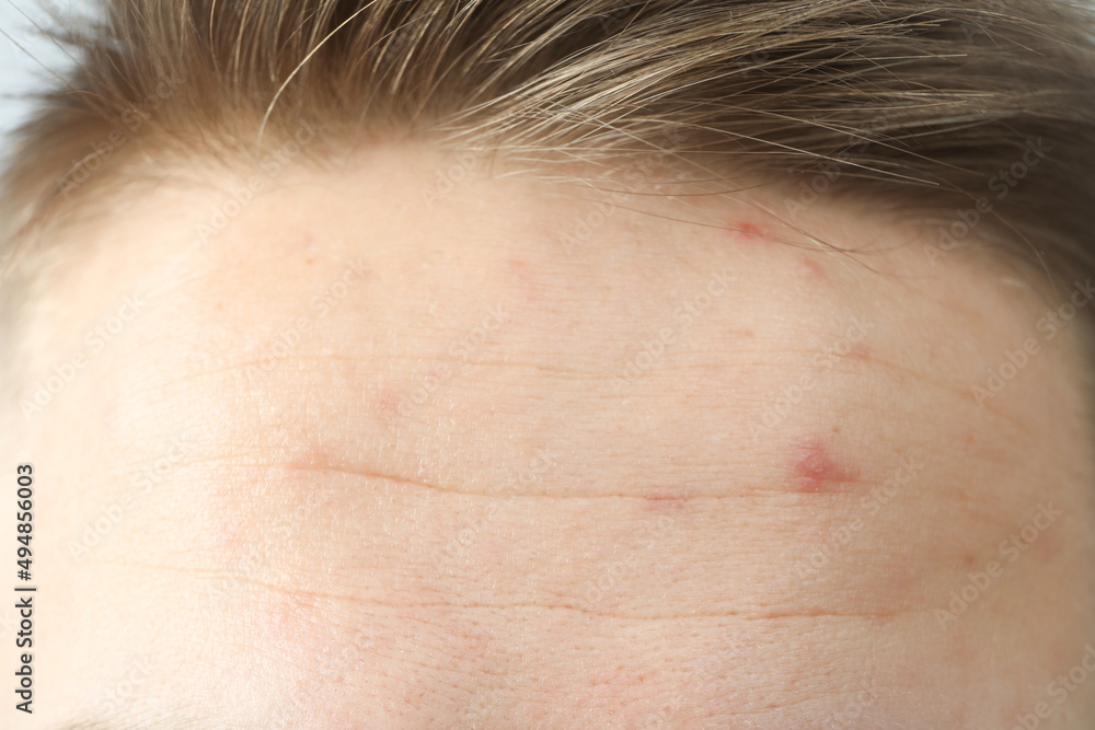 Concept of skin care with problem skin, close up