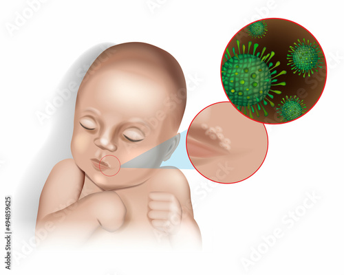 Vector illustration of the herpes virus on the lip of a child.Acute herpetic stomatitis in children. Infectious viral disease Herpes simplex virus. VZV