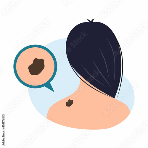 Young woman with birthmark in neck area. World Melanoma Day. Cancerous tumor. Vector illustration on topic of medicine and health problems. photo