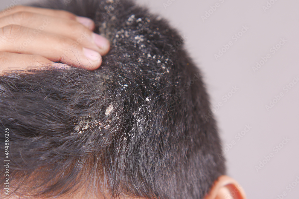 men with dandruff in his hair, closeup men with dandruff in his hair, closeup