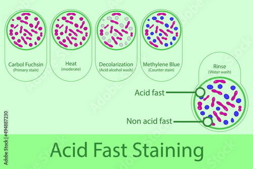 Acid fast staining technique steps diagram, using Carbol fuchsine and methylene blue vector illustration eps10