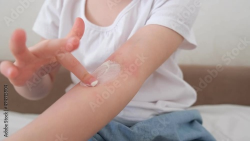 The child scratches atopic skin. The child applies a special cream to atopic skin. Dermatitis, diathesis, allergy on the child's body.  photo
