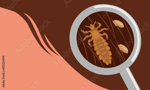 Vector illustration, head lice or Pediculus humanus capitis with eggs stuck to hair. photo