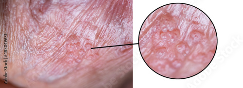 Macro photo of human hpv papillomavirus, man with skin lesion by virus photo
