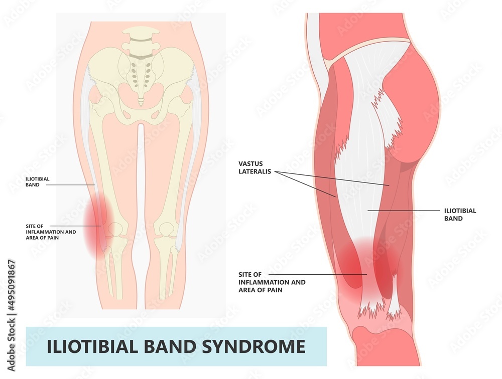 Muscle Rupture Thigh Thigh treat athlete tear sprain muscle inflammatory runner cycling ...