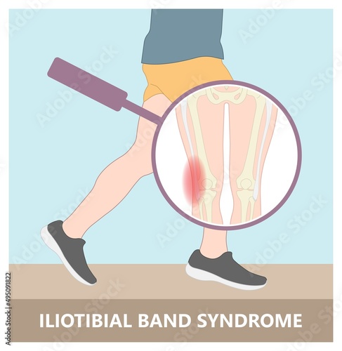 Stretching treat athlete tear sprain muscle inflammatory runner cycling hiking shot knee hip pain sport IT band Pes bursa tract medial soccer tibia femoris RICE Rest ice elevation method strain