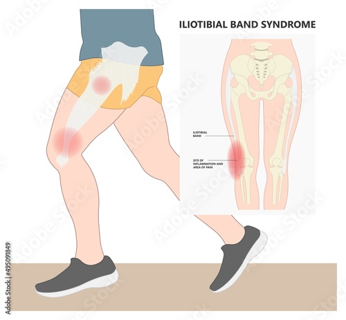 inflammatory femoris Stretching treat athlete tear sprain muscle runner cycling hiking shot knee hip pain sport IT band Pes bursa tract medial soccer tibia RICE Rest ice elevation method strain