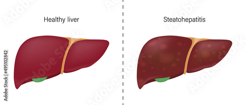 Comparison of the difference between normal liver and steatohepatitis. Liver disease for medical education and science.