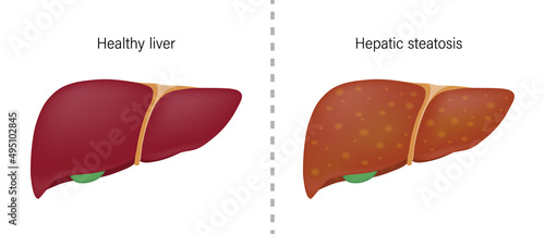 Comparison of the difference between normal liver and hepatic steatosis. Liver disease for medical education and science.