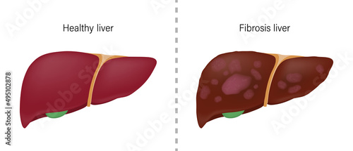 Comparison of the difference between normal liver and fibrosis. Liver disease for medical education and science.