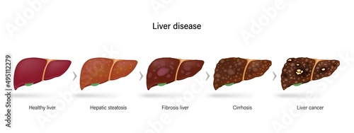 Liver disease. Stages of liver damage. Healthy liver, hepatic steatosis , fibrosis, cirrhosis and liver cancer. photo