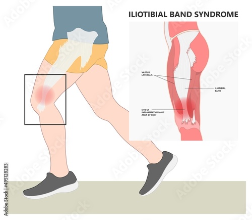 Stretching treat athlete tear sprain muscle inflammatory runner cycling hiking shot knee hip pain sport IT band Pes bursa tract medial soccer tibia femoris RICE Rest ice elevation method strain photo