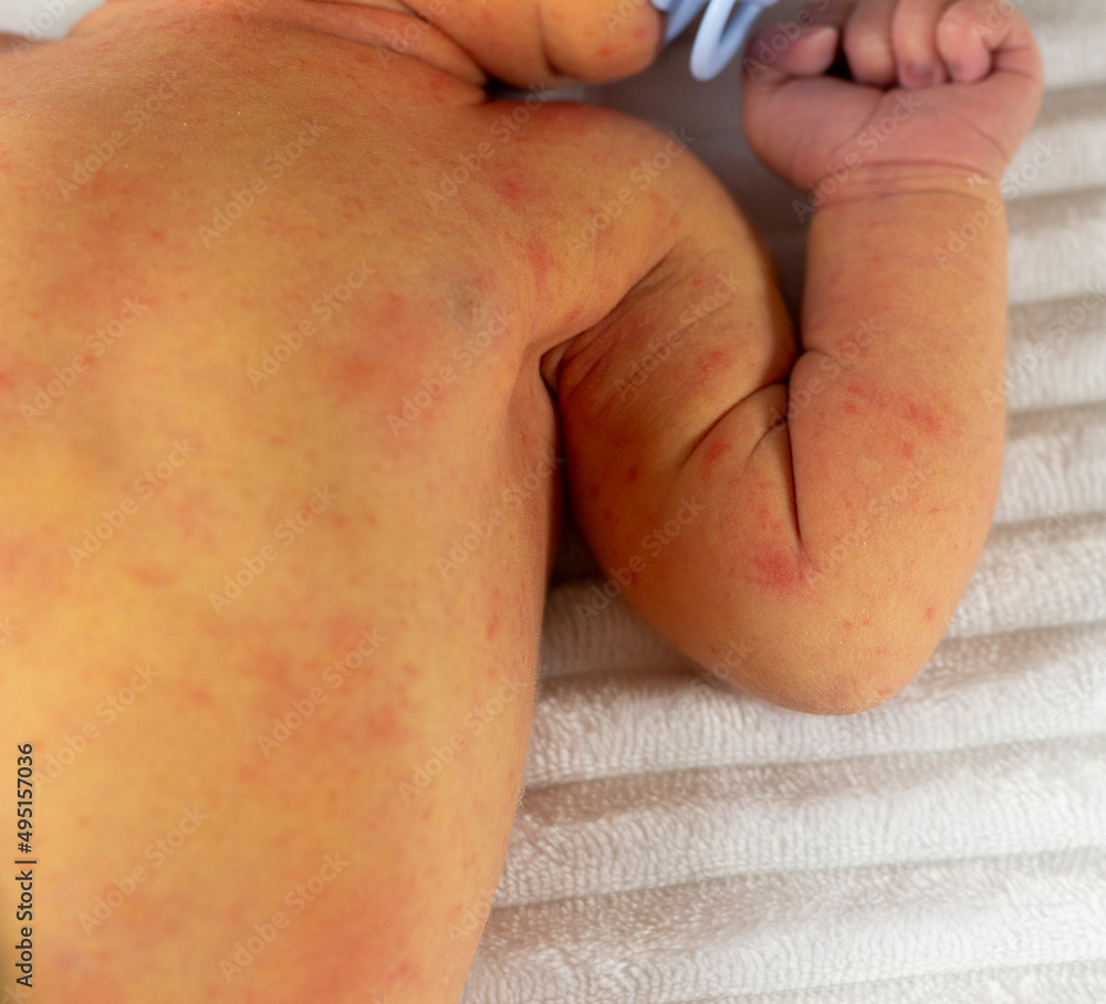 Fototapeta premium yellowish neonatal jaundice of the skin occurs in newborns in the first days of birth