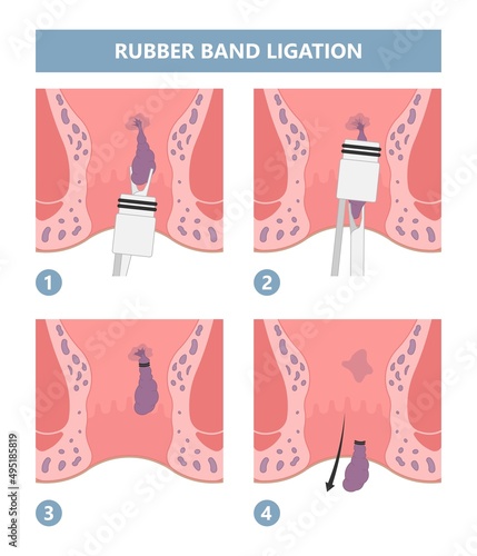 Thrombectomy thrombosis removal piles swollen blood anus treat band surgical home sitz baths colon cancer examine rectum pain ligator clots stapler PPH Laser regular lump Digital anal canal  fistula 
