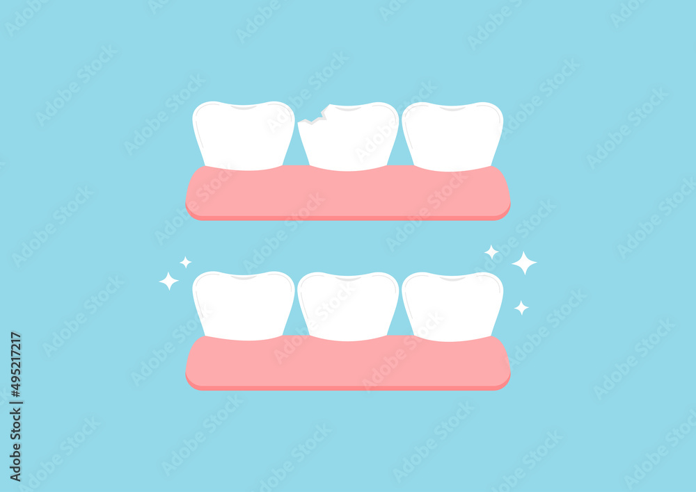 Injury chipped tooth and healthy tooth before, after treatment icon set. Broken teeth with problem treatment concept. Flat cartoon style vector illustration. Injury chipped tooth and healthy tooth before, after treatment icon set. Broken teeth with problem treatment concept. Flat cartoon style vector illustration.