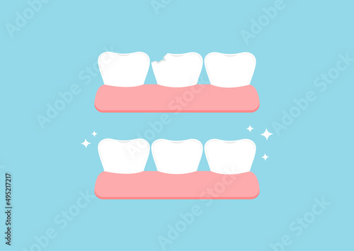 Injury chipped tooth and healthy tooth before, after treatment icon set. Broken teeth with problem treatment concept. Flat cartoon style vector illustration.