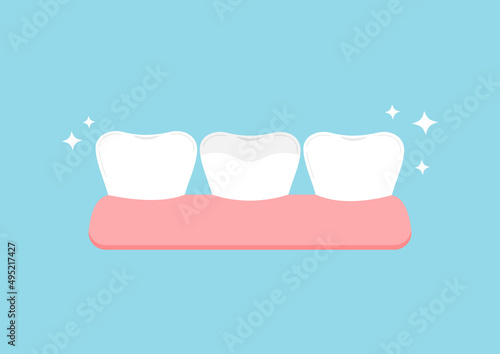 Teeth with ceramic overlay in gym dental icon. Tooth dentistry restoration with ceramic porcelain sealant in cavity treatment concept. Flat cartoon clip art vector illustration.