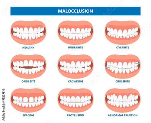 mouth open deep bad bite teeth gum Joint pain jaw surgery corrective bone oral smile Lower Weak Chin health extra Spacing Anterior fixed photo