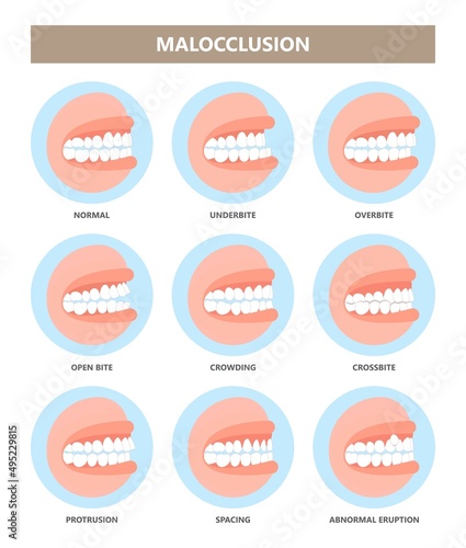 Corrective jaw surgery oral health mouth open deep bad bite teeth gum Joint pain bone smile lower weak Chin extra Spacing Anterior fixed