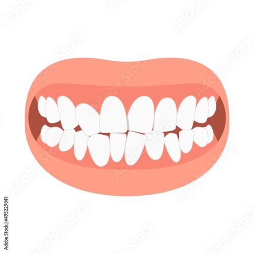bad bite teeth mouth open deep gum Joint pain jaw surgery corrective bone oral smile Lower Weak Chin health extra Spacing Anterior fixed photo