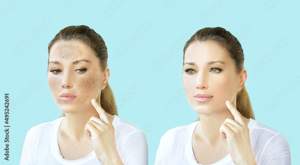 Dark spots, freckles,hyperpigmentation(melasma or chloasma),concept - skin lightening, skin whitening, fruit acids,AHA, Skin Brightening. Dark spots, freckles,hyperpigmentation(melasma or chloasma),concept - skin lightening, skin whitening, fruit acids,AHA, Skin Brightening.