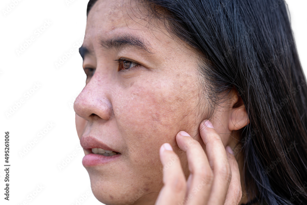 Obraz premium Close up of Asian adult woman face has freckles, large pores, blackhead pimple and scars problem from not take care for a long time. Soft focus of skin problem face. Treatment and Skincare concept