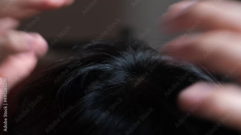 Asian men split their hair to reveal hair loss.	
