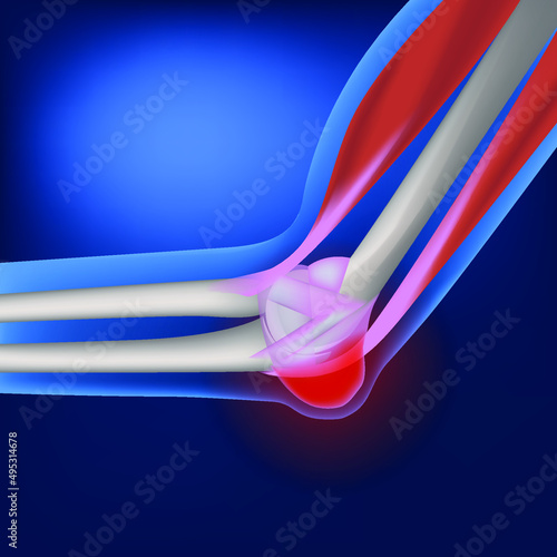 bursitis of the elbow joint. Anatomy of the bones of the hands. Limb on a blue background. Vector illustration