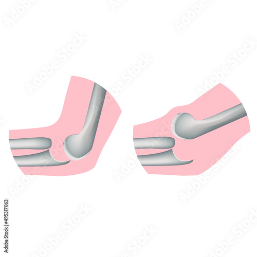 Varieties of vivices of the elbow joint. Round icons. Vector illustration