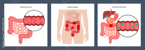 Intestines diseases concept