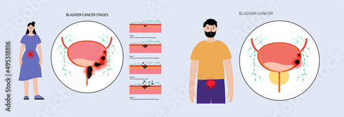 Bladder cancer stages