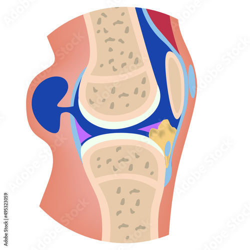 baker's cyst. Anatomy of the knee with damage to the articular capsule and leakage of the synovial substance. Vector illustration