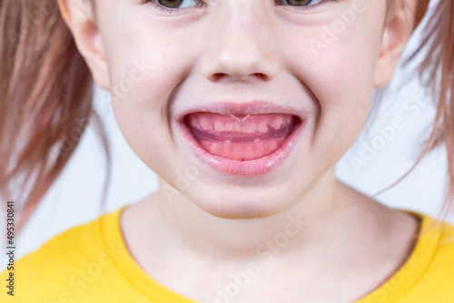 Six-year old caucasian girl shows myofunctional trainer in her mouth photo