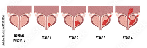 Medical diagram of 4 stages of prostate cancer. tumor grows and penetrates into neighboring organs and tissues.