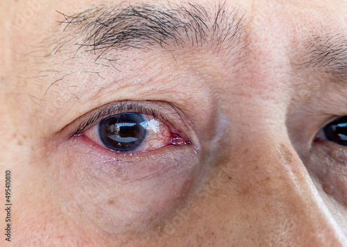 A person with a red inflamed watery eye caused by bacterial infection or a severe reaction of hay fever.