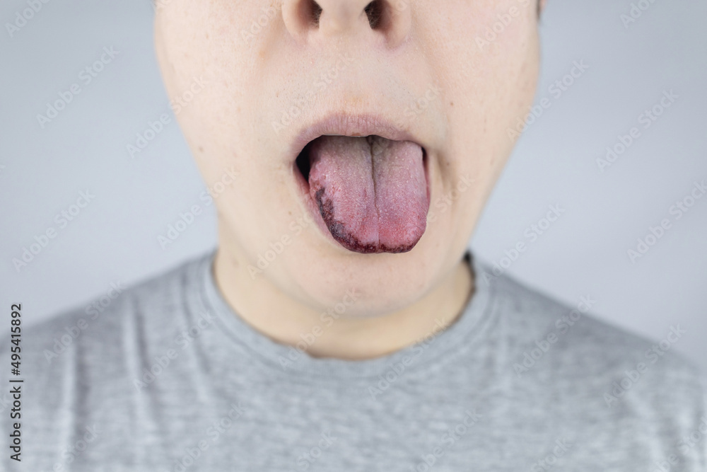 Black tongue. A man shows the consequences of an injury, bite or burn