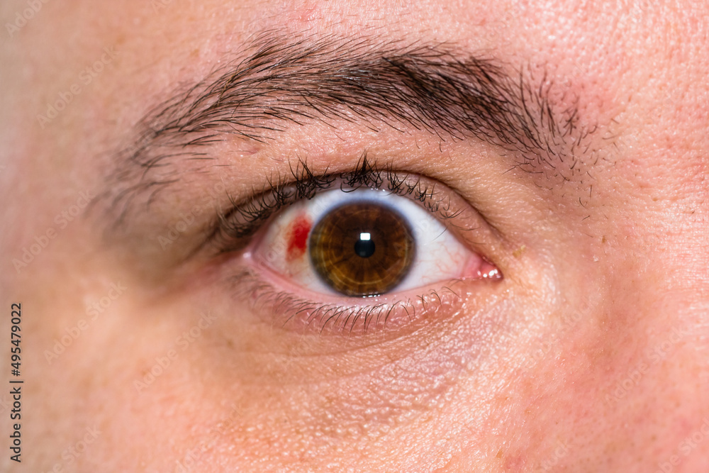 Eye Injury Young Man With Burst Blood Vessel In Eye Fatigue Problems hemorragia-animado